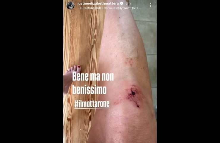 ginocchio graffiato justine mattera